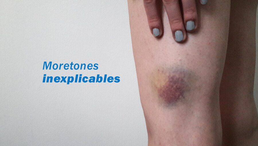 ¿Qué causa la púrpura trombocitopénica idiopática?